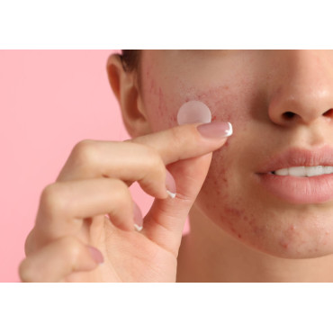 Mikroihličkové náplasti na akné