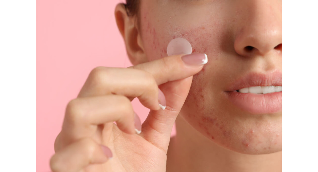 Mikroihličkové náplasti na akné