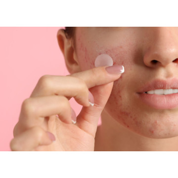 Mikroihličkové náplasti na akné